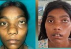 ग्रेटर नोएडा में सफल स्कारलेस सर्जरी, 22 साल की युवती को मिली नई मुस्कान