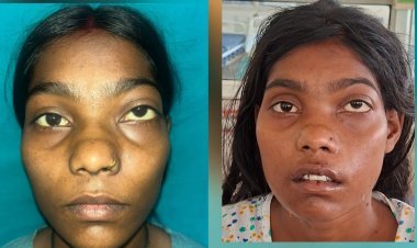 ग्रेटर नोएडा में सफल स्कारलेस सर्जरी, 22 साल की युवती को मिली नई मुस्कान