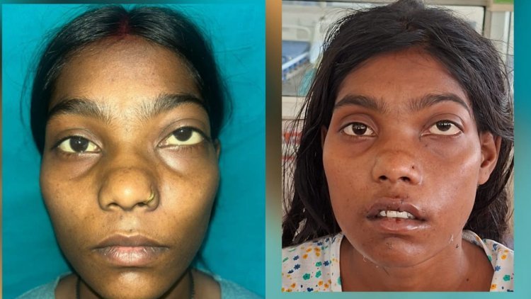 ग्रेटर नोएडा में सफल स्कारलेस सर्जरी, 22 साल की युवती को मिली नई मुस्कान